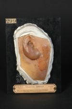 Lupus hypertrophique de la joue. Lupus myxomateux de l'oreille droite. Femme âgée de 37 ans, fleuris [...]