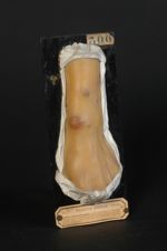 Éruption bromo-potassique, à forme pustuleuse et tuberculo-papillomateuse, de l'avant-bras. Femme âg [...]