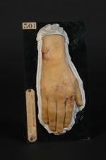 Erythème polymorphe, variété hydroïque : herpès iris. Homme âgé de 21 ans, terrassier (V. le n° 302  [...]