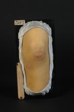 Erythème polymorphe, variété hydroïque ; herpès iris. Homme âgé de 21 ans, terrassier (V. le n° 301  [...]