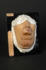 Syphilome végétant de la lèvre, du menton et de la voûte palatine ; papillome deutéropathique dévelo [...]