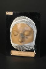 Syphilide tuberculo-ulcéreuse superficielle, forme serpigineuse, de la face