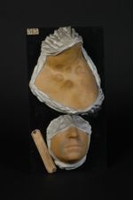 Plaques syphilitiques circinées du cou et de la face avec pigmentation entourant la partie centrale  [...]