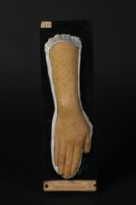 Lentiginose profuse de l'avant-bras et de la main (Inv. 1922). Femme âgée de 19 ans, passementière ( [...]