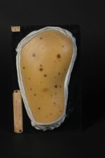 Lentiginose profuse de la région fessière (Inv. 1922). Femme âgée de 19 ans, passementière (V. le n° [...]