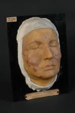 Acné polymorphe de la face, avec prédominance des lésions pustuleuses (Inv. 1922). Homme âgé de 17 a [...]