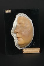 Lupus tuberculeux miliaire de la face, forme rare. Tous les tubercules typiques sont isolés. Femme â [...]