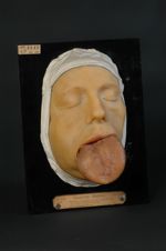 Épithéliome spino-cellulaire de la langue, forme plongeante el infiltrante par lymphangite cancéreus [...]