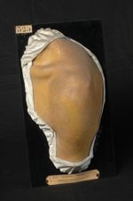 Trichophytie circinée de l'épaule ; herpès iris parasitaire. Homme âgé de 58 ans, maçon