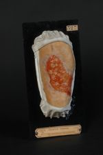 Ulcère simple de jambe ; greffes épidermiques. Femme âgée de 49 ans, cuisinière