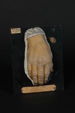 Psoriasis de la main droite. Noter le psoriasis des ongles et l'hyperkératose du lit, surtout marqué [...]