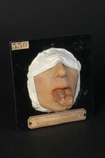 Syphilome tertiaire ulcéré de la langue