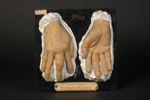 Dactylite syphilitique de la main droite. Homme âgé de 41 ans, cordonnier