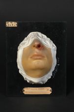 Lupus tuberculeux ulcéreux du nez, à marche rapide