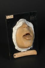 Glossite syphilitique ; forme scléreuse ; période secondo-tertiaire. Homme âgé de 29 ans, fumiste