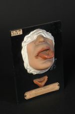 Syphilome en nappe de la langue et de la lèvre inférieure. Homme âgé de 40 ans, peintre en bâtiment