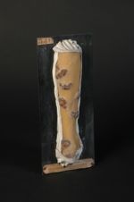 Tuberculose cutanée. Gommes tuberculeuses ; gommes dermiques et hypodermiques de l'avant-bras