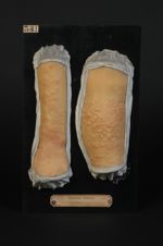 Erythème polymorphe à forme huileuse. Homme âgé de 72 ans, fleuriste