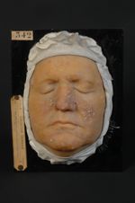 Acné rosée, couperose érythémato-pustuleuse. Homme âgé de 35 ans