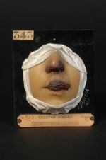 Lupus tuberculo-gommeux du nez et de la lèvre supérieure. Fillette âgée de 12 ans