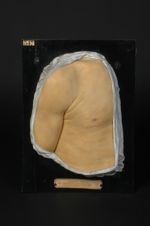 Mycosis fongoïde. Érythème roséoliforme légèrement infiltré et, par endroits, squameux (Inv. 1922).  [...]