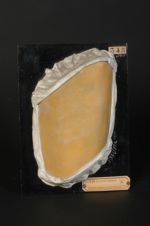 Sclérodermie en plaques ; morphée de la cuisse. Fillette âgée de 18 mois