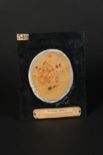 Hydroa vacciniforme de Bazin (Inv. 1922). Enfant âgé de 18 mois. Syphilide vacciniforme escharotique