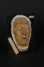 Vitiligo de la face. Homme âgé de 68 ans, terrassier