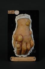 Dermite huileuse du dos de la main . Femme âgée de 33 ans, blanchisseuse