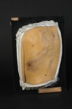 Syphilides ulcéreuses serpigineuses du dos