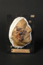 Naevocarcinome ; foyer initial ; dissémination de tumeurs à son voisinage ; adénopathies (Inv. 1922) [...]