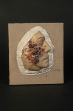 Naevocarcinome ; foyer initial ; dissémination de tumeurs à son voisinage ; adénopathies (Inv. 1922) [...]