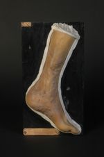 Varices lymphatiques ulcérées, d'origine vraisemblablement tuberculeuse (Inv. 1922). Homme âgé de 37 [...]