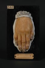 Eczéma chronique des doigts et des ongles. Homme âgé de 69 ans, tisseur