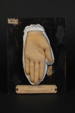 Plaques syphilitiques (Inv. 1922). Syphilide papulo-squameuse de la paume de la main. Femme âgée de  [...]