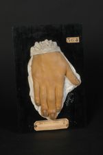 Onychose ; lésion héréditaire non syphilitique des ongles. Homme âgé de 26 ans, maçon. (V. le n° 119 [...]
