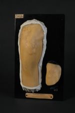 Chéloïdes multiples de la cuisse et du genou. Homme âgé de 28 ans, employé