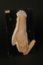 Pityriasis rubra pilaire. Maladie de Devergie. Granité général et desquamation pityriasique, exagéra [...]