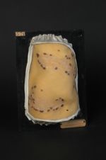 Syphilide tuberculo-ulcéreuse à forme serpigineuse