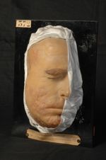 Trichophytie circinée et sycosique de la barbe et du cuir chevelu