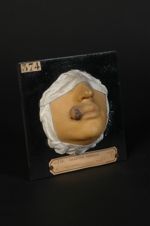Chancre syphilitique de la lèvre supérieure. Homme âgé de 20 ans, fumiste