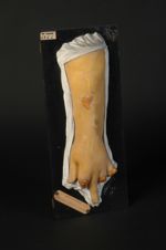 Syphilis mutilante de la main