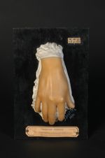Sclérodactylie avec mutilation des doigts et altérations des ongles (Inv. 1922). Sclérodermie ; sclé [...]