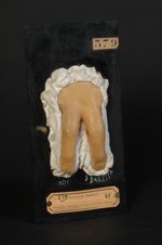 Ulcérations arsenicales des doigts