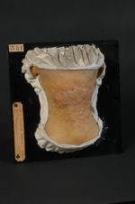 Acné chéloïdienne de la nuque. Homme âgé de 36 ans, scieur de long