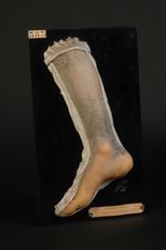 Ichtyose cornée (sauriasis). Homme âgé de 15 ans, sans profession