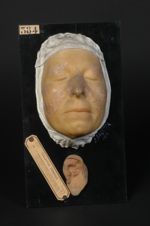 Lupus érythémato-acnéique de la face et de l'oreille, herpès crétacé de Devergie (moulage décoloré,  [...]