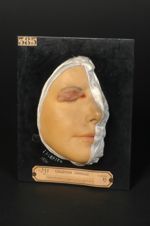 Lupus tuberculeux de la paupière supérieure. Homme âgé de 31 ans, journalier