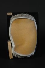 Syphilide papuleuse folliculaire de l'abdomen et de la hanche (étiquetée primitivement : syphilide h [...]