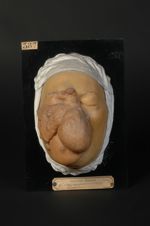 Naevus : fibrome molluscum de la face (Inv. 1922) chez un horloger. Naevus hypertrophique de la face